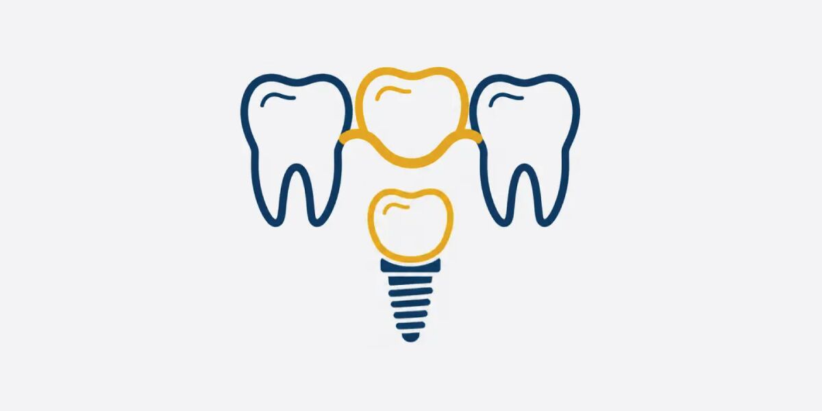 Illustration of dental bridge and implant restoration options for replacing a missing tooth.